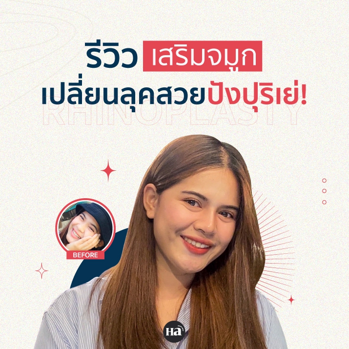 รีวิว เสริมจมูก เปลี่ยนลุคสวยสุดปังปุริเย่!