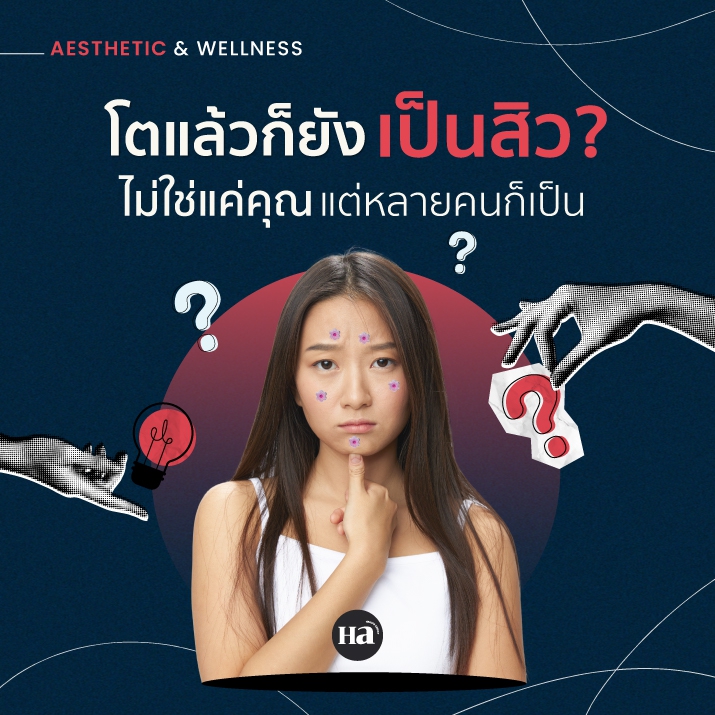 สิวไม่ใช่แค่เรื่องของวัย เพศ หรือฮอร์โมนเพียงอย่างเดียว