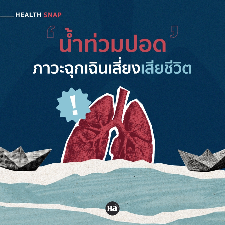 น้ำท่วมปอด ... ภาวะแทรกซ้อนที่อันตรายถึงชีวิต